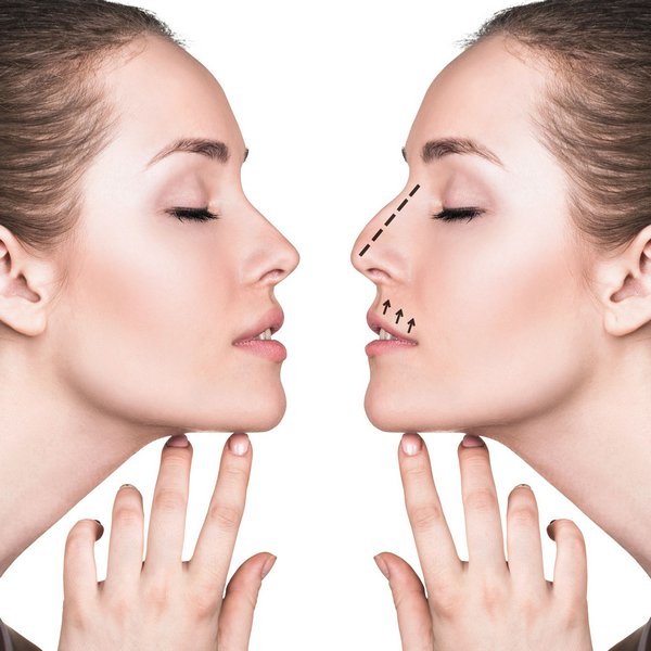 rhinoplasty definition