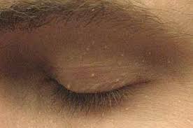 Genital Warts Treatment